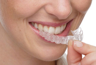 Invisalign braces, Calgary